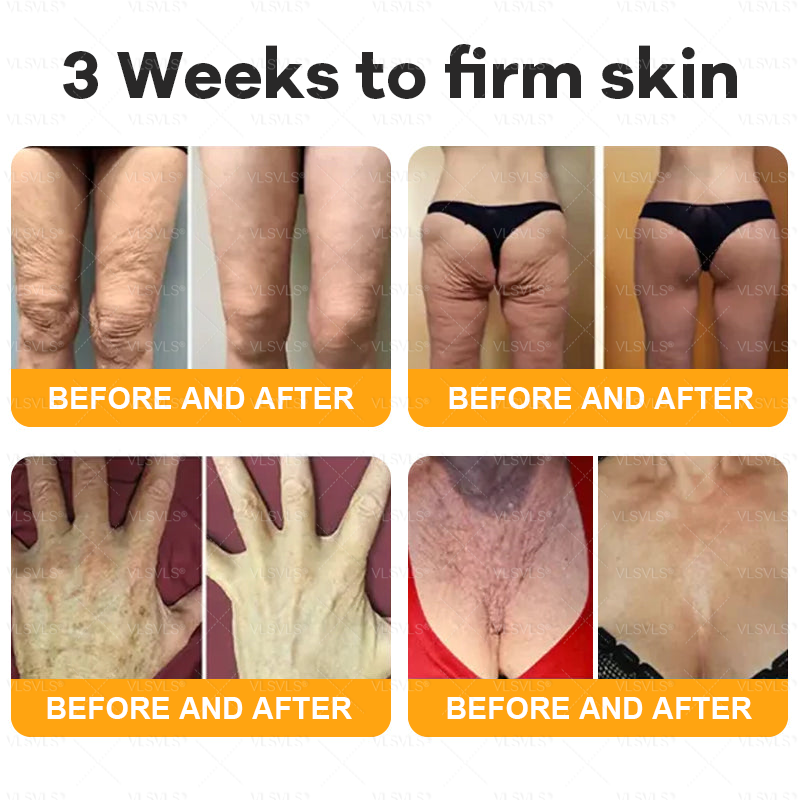 Made and Shipped from UK 🎗️🎗️VLSVLS® Bee Venom Comprehensive Cream  LAST DAY 80% OFF (Suitable for all ages)