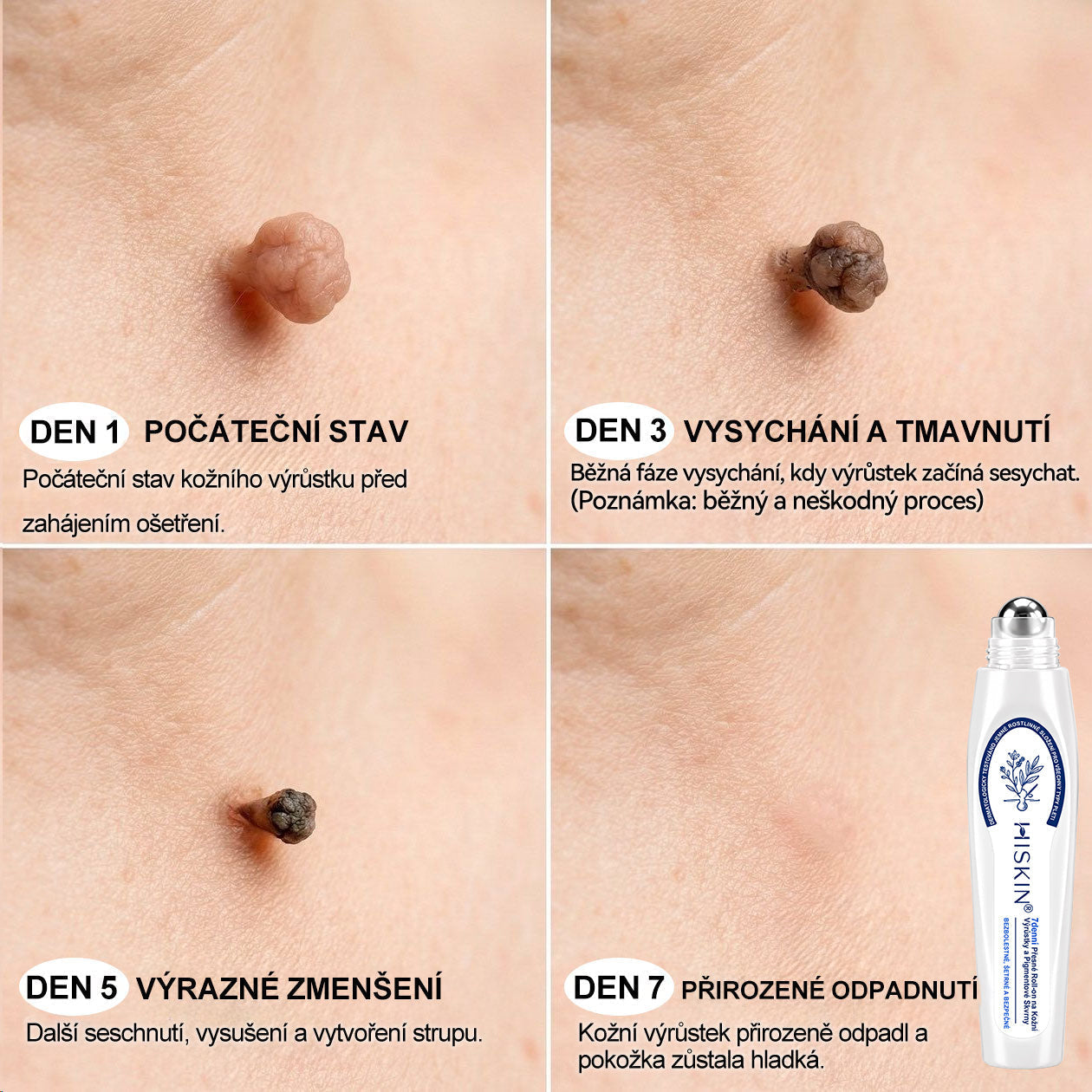 🎁 Zbývá už jen 5 kusů! Extra sleva 50 % 👩‍⚕️ Oficiální obchod Hiskin® – 7denní roll-on na odstranění skvrn a pigmentu, bezbolestný, nezanechává jizvy🐬 👉 Nenechte si ujít tuto příležitost, bude skladem až do konce roku!